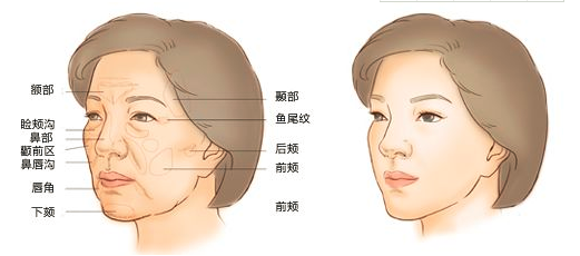 自體脂肪填充淚溝能保持幾年