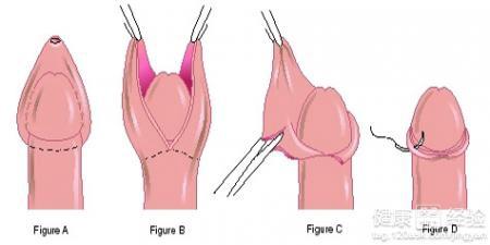 割包皮手術(shù)要多長時間
