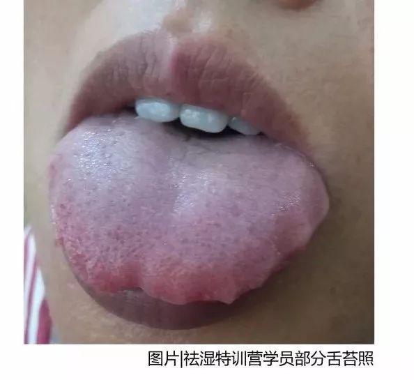 舌頭兩邊鋸齒狀是什么原因