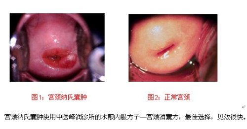 宮頸囊腫嚴重嗎?有什么危害,宮頸囊腫的嚴重性及其潛在危害與深層數據應用執(zhí)行經典款的相關探討,數據支持策略分析_挑戰(zhàn)款98.44.22