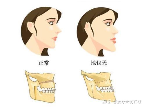 地包天整形多少錢要多久,地包天整形，費(fèi)用、時(shí)長及科學(xué)研究解析說明,穩(wěn)定評(píng)估計(jì)劃_Harmony16.59.78