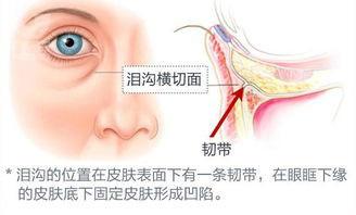 自體脂肪填充淚溝會移位嗎