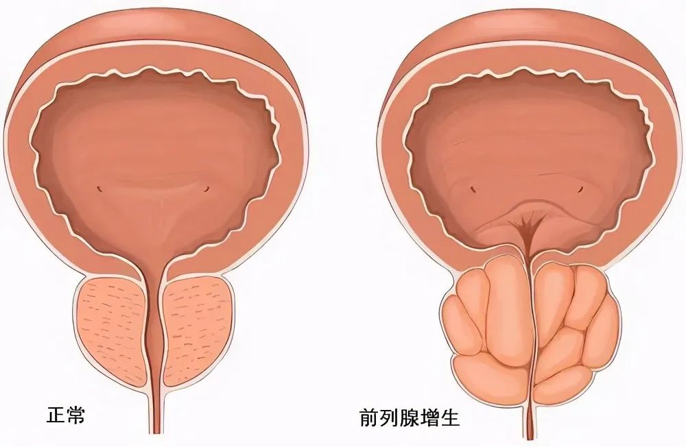 前列腺病有什么癥狀表現(xiàn)