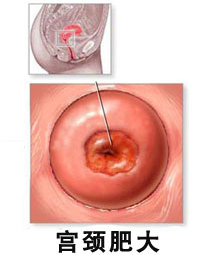 宮頸肥大糜爛怎么治療