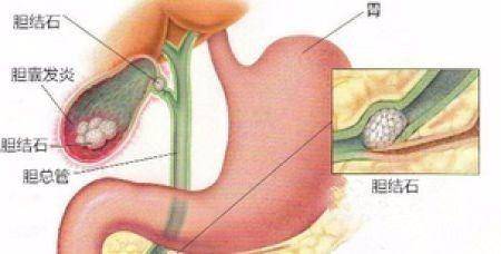 女子膽囊內(nèi)竟藏400多顆結(jié)石全面解析說明_進(jìn)階款65.37.68