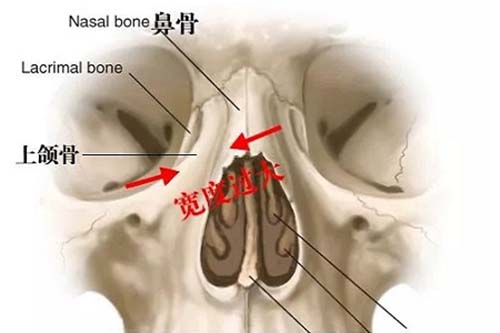 女子鼻骨骨折消腫后喜提高鼻梁先進(jìn)技術(shù)執(zhí)行分析_app47.73.41